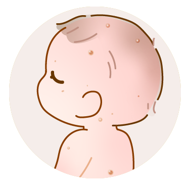 図2:JXGの症状(皮疹)(赤ちゃんの後頭部のイラスト)